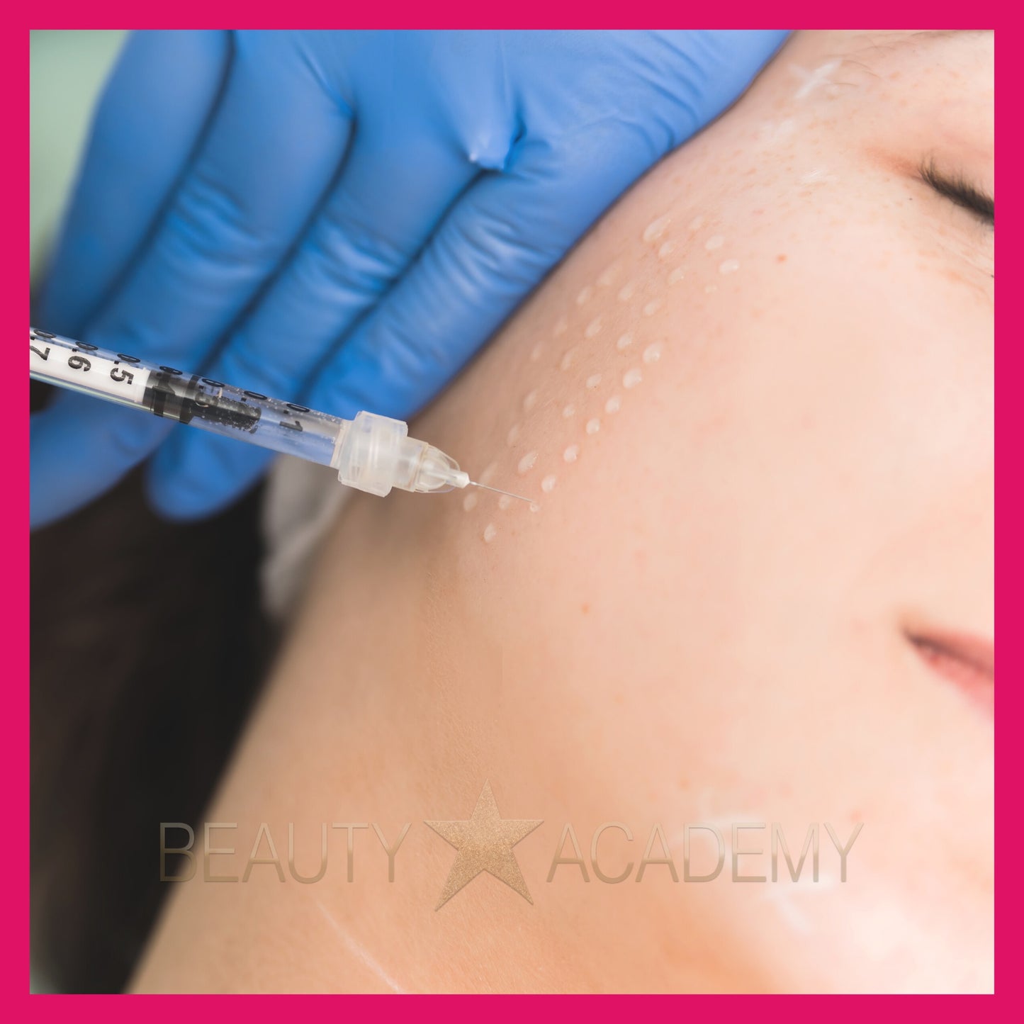 Mesotherapy & Microneedling Treatment